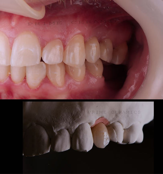 Anthony Bayley: Why Whitepeaks Hyperion is my Number One Choice for Aesthetic Restorations