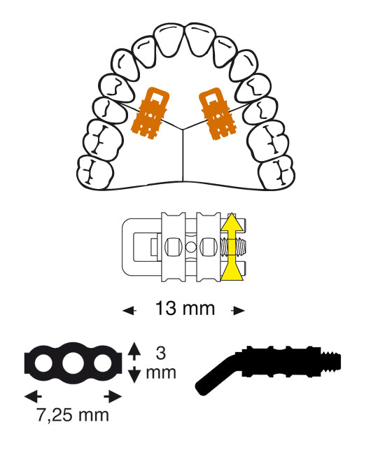 Micro Sectional Screw with Bent U-Shaped Guide Pin