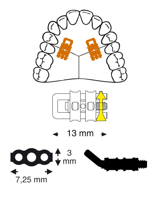 Micro Sectional Screw with Bent U-Shaped Guide Pin