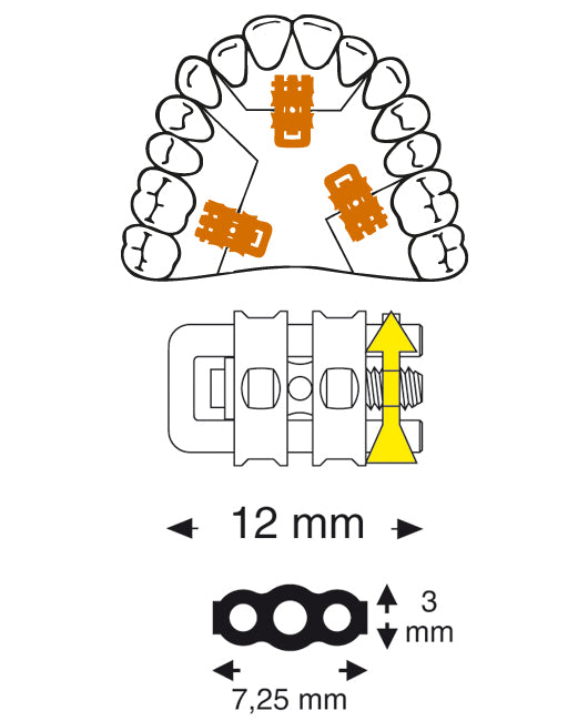 Micro Sectional Screw with Straight U-Shaped Guide Pin