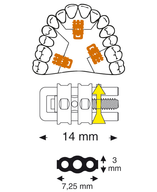 Micro Sectional Screw with Straight U-Shaped Guide Pin