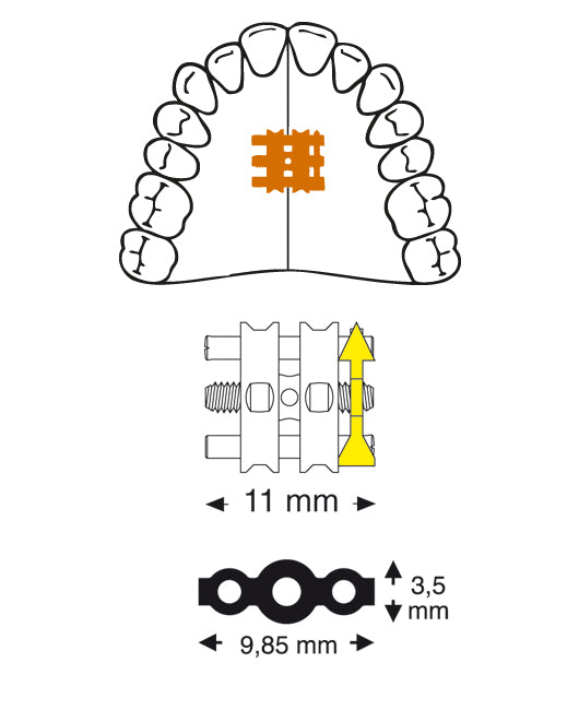 Standard Screw for Upper Appliances