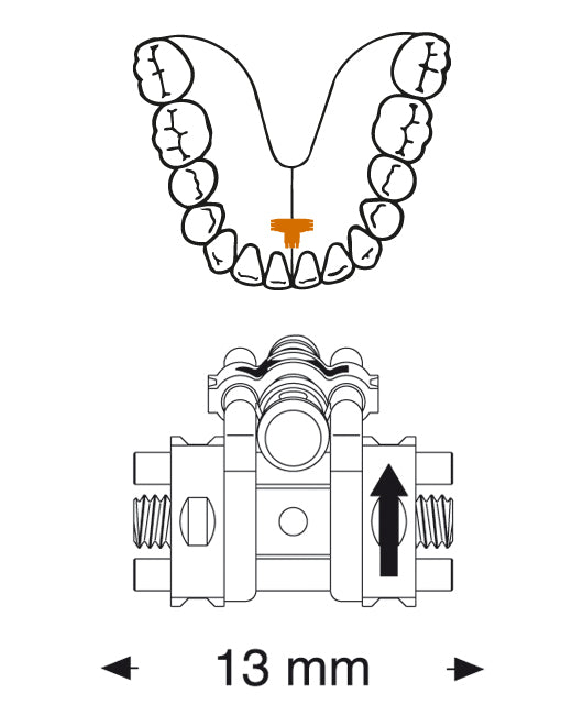 Three Directional Screw Anatomical for Lower Arch